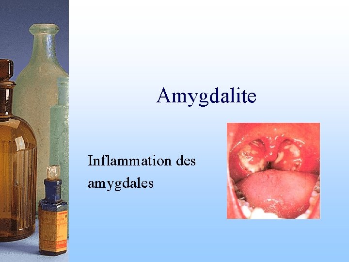 Amygdalite Inflammation des amygdales 