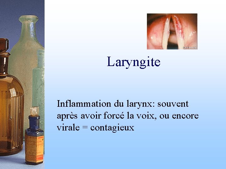 Laryngite Inflammation du larynx: souvent après avoir forcé la voix, ou encore virale =