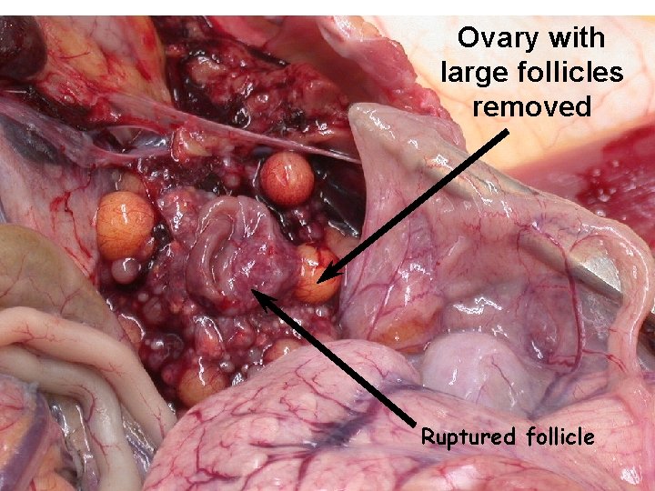 Ovary with large follicles removed Ruptured follicle 