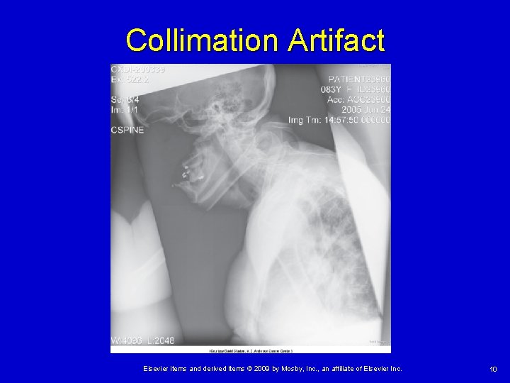 Collimation Artifact Elsevier items and derived items © 2009 by Mosby, Inc. , an