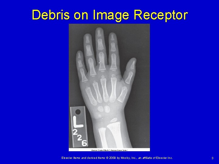 Debris on Image Receptor Elsevier items and derived items © 2009 by Mosby, Inc.