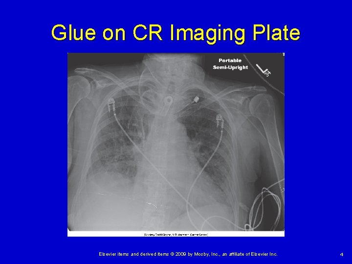 Glue on CR Imaging Plate Elsevier items and derived items © 2009 by Mosby,