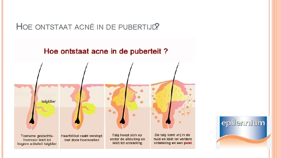 HOE ONTSTAAT ACNÉ IN DE PUBERTIJD? 