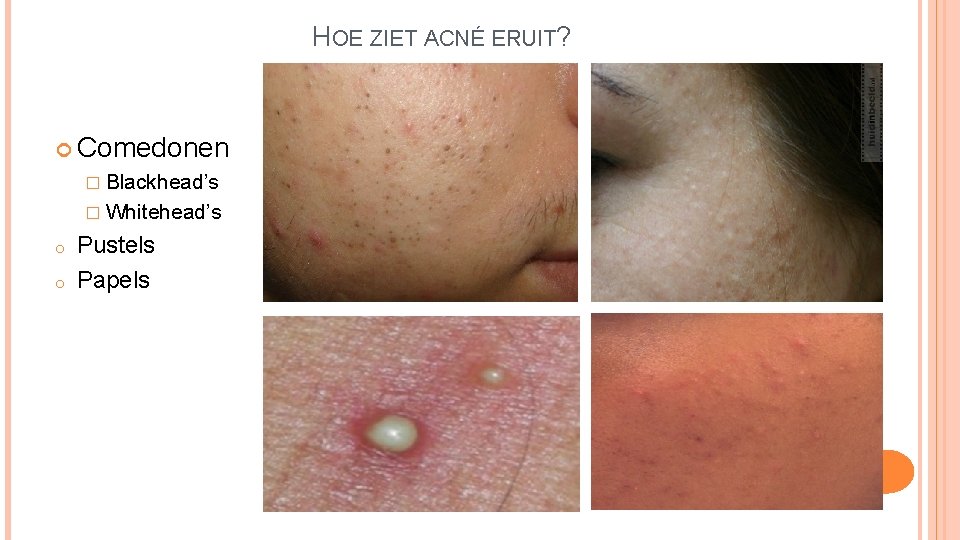 HOE ZIET ACNÉ ERUIT? Comedonen � Blackhead’s � Whitehead’s o o Pustels Papels 