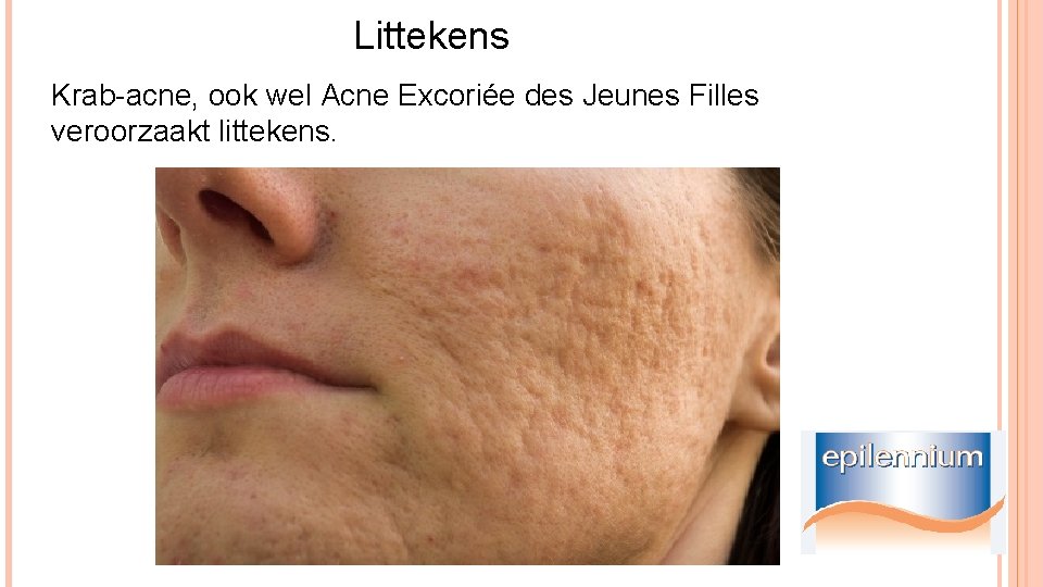 Littekens Krab-acne, ook wel Acne Excoriée des Jeunes Filles veroorzaakt littekens. 