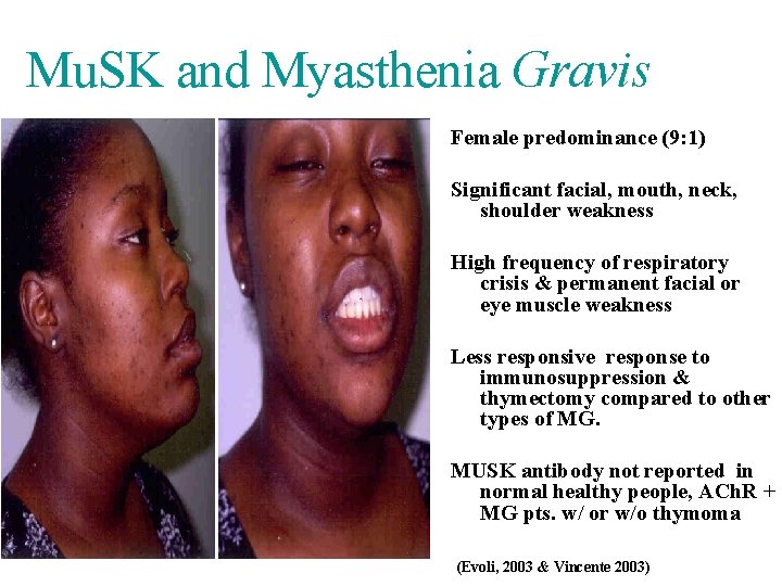 Mu. SK and Myasthenia Gravis Female predominance (9: 1) Significant facial, mouth, neck, shoulder