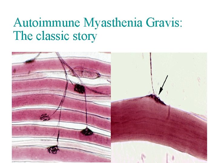 Autoimmune Myasthenia Gravis: The classic story 