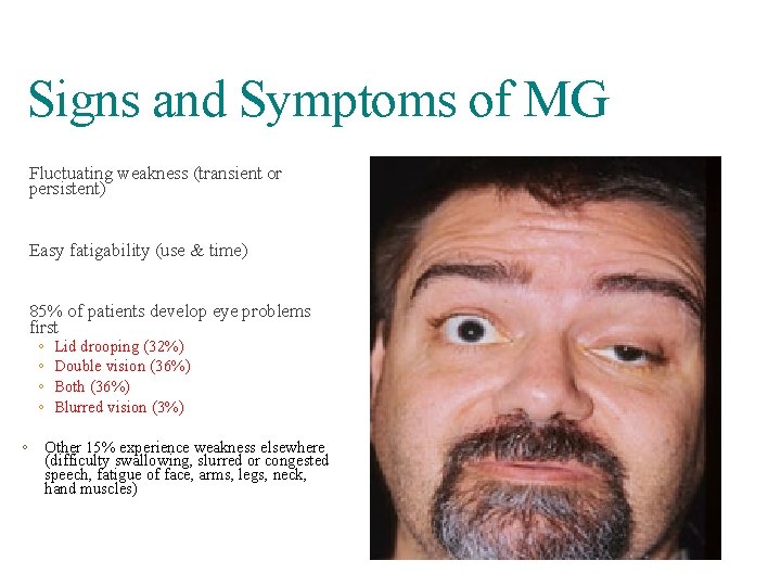 Signs and Symptoms of MG Fluctuating weakness (transient or persistent) Easy fatigability (use &