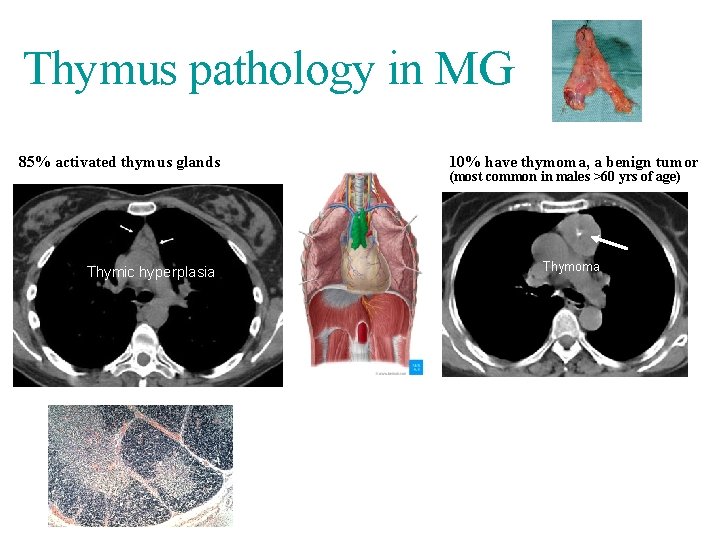 Thymus pathology in MG 85% activated thymus glands Thymic hyperplasia 10% have thymoma, a