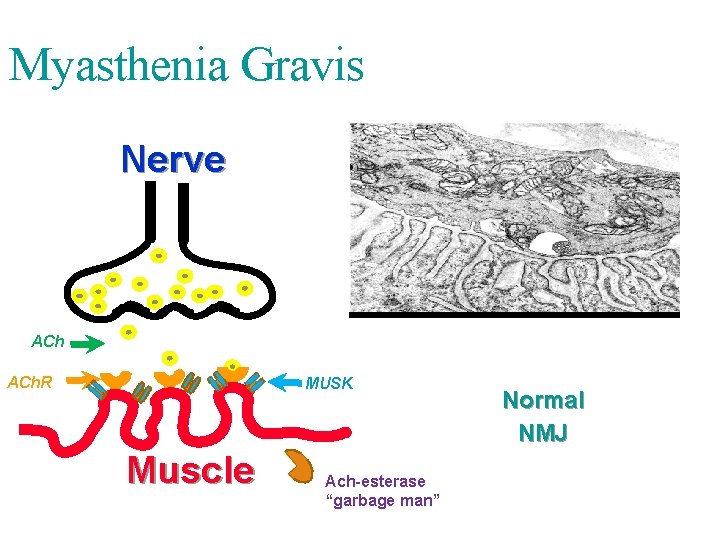 Myasthenia Gravis Nerve ACh. R MUSK Muscle Ach-esterase “garbage man” Normal NMJ 
