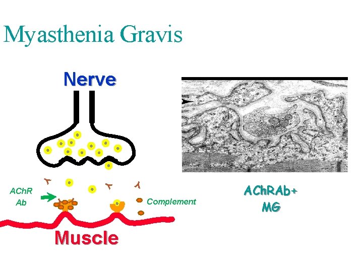Myasthenia Gravis Nerve Y Y Y Muscle Y Y ACh. R Ab Complement ACh.