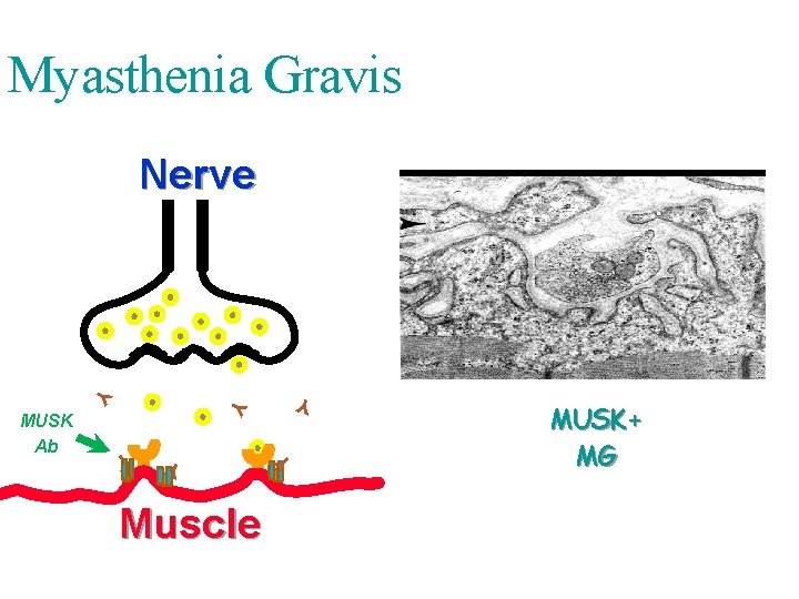 Myasthenia Gravis Nerve Y Y Muscle Y Y MUSK Ab MUSK+ MG 