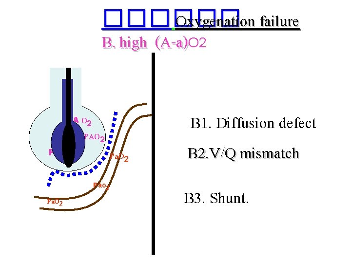 ������ Oxygenation failure B. high (A-a)O 2 PA O 2 PAO 2 Pa. O