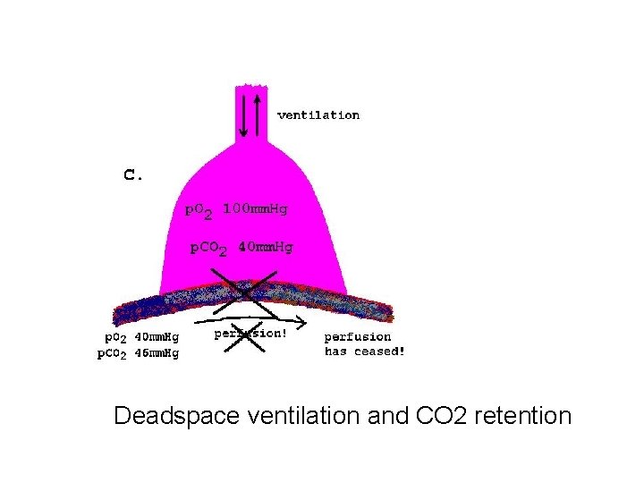 Deadspace ventilation and CO 2 retention 