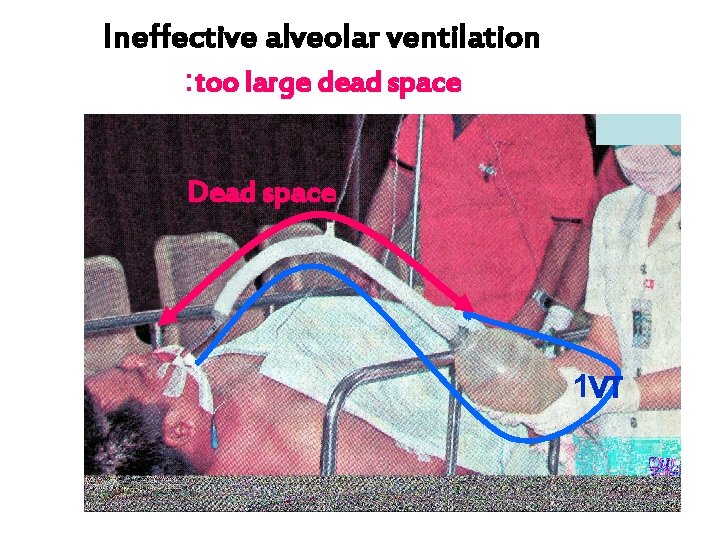 Ineffective alveolar ventilation : too large dead space Dead space 1 VT 