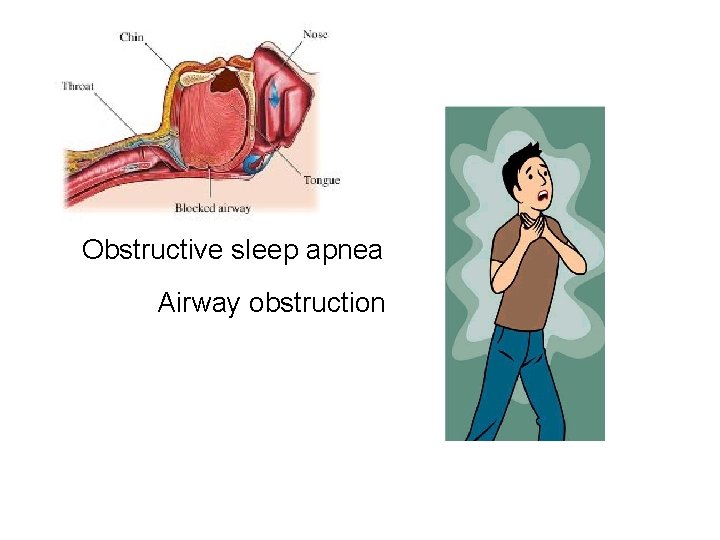 Obstructive sleep apnea Airway obstruction 