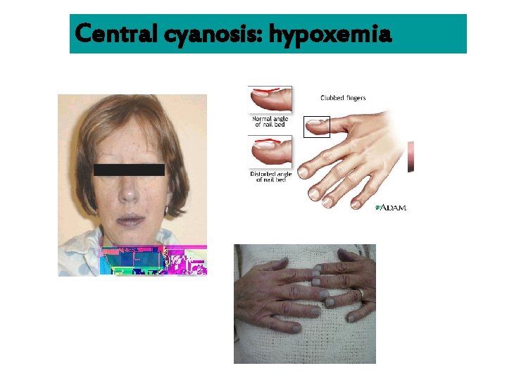 Central cyanosis: hypoxemia 