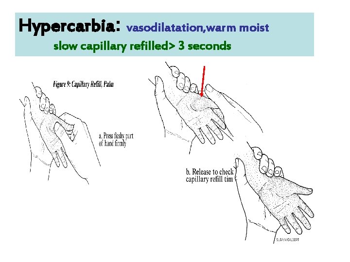 Hypercarbia: vasodilatation, warm moist slow capillary refilled> 3 seconds 