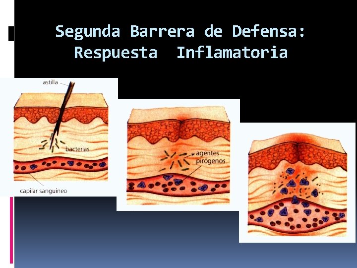 Segunda Barrera de Defensa: Respuesta Inflamatoria 