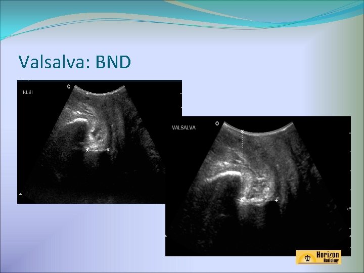 Valsalva: BND 