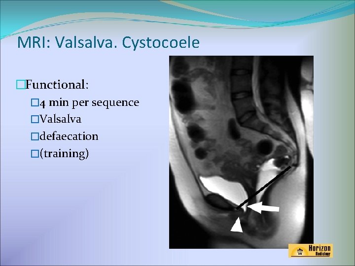 MRI: Valsalva. Cystocoele �Functional: � 4 min per sequence �Valsalva �defaecation �(training) 