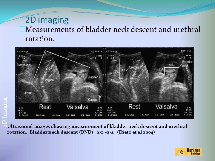 2 D imaging 2 D Imaging �Measurements of bladder neck descent and urethral rotation.