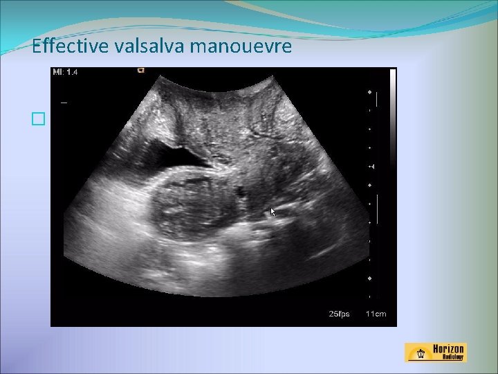 Effective valsalva manouevre � 