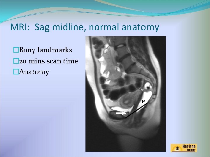 MRI: Sag midline, normal anatomy �Bony landmarks � 20 mins scan time �Anatomy 