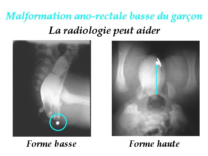 Malformation ano-rectale basse du garçon La radiologie peut aider Forme basse Forme haute 