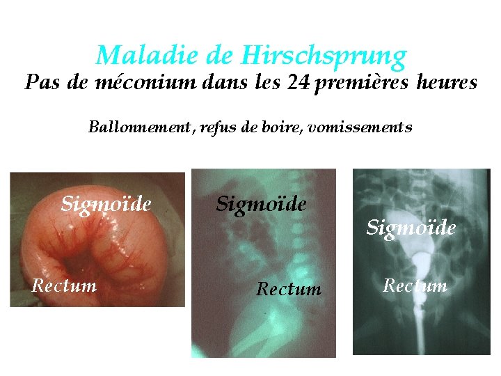 Maladie de Hirschsprung Pas de méconium dans les 24 premières heures Ballonnement, refus de