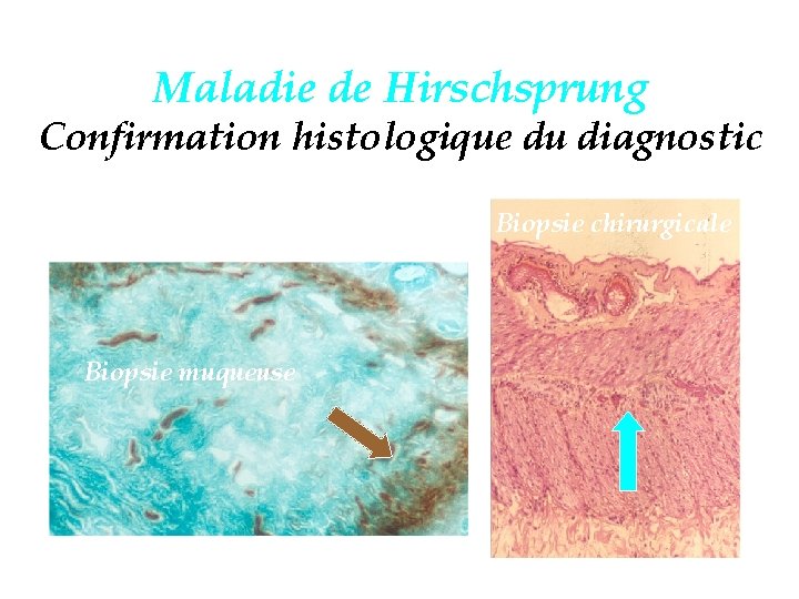 Maladie de Hirschsprung Confirmation histologique du diagnostic Biopsie chirurgicale Biopsie muqueuse 