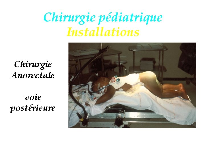 Chirurgie pédiatrique Installations Chirurgie Anorectale voie postérieure 