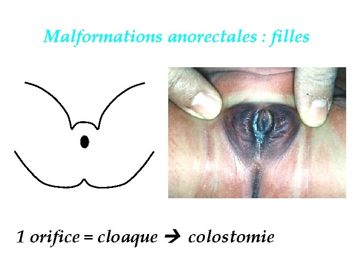 Malformations anorectales : filles 1 orifice = cloaque colostomie 