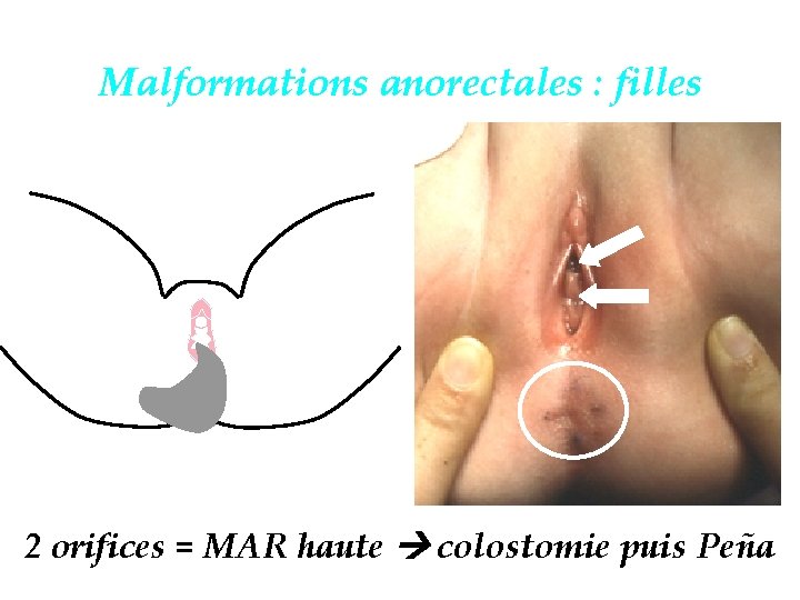 Malformations anorectales : filles 2 orifices = MAR haute colostomie puis Peña 