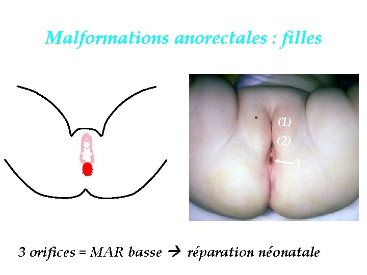 Malformations anorectales : filles (1) (2) 3 3 orifices = MAR basse réparation néonatale