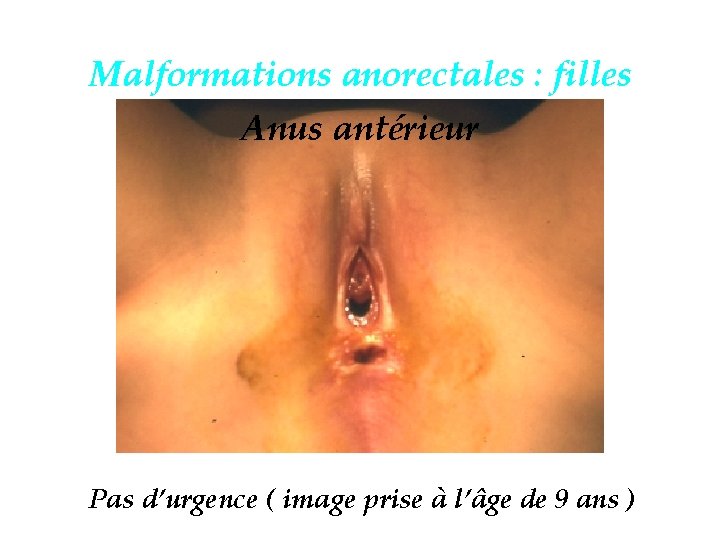 Malformations anorectales : filles Anus antérieur Pas d’urgence ( image prise à l’âge de
