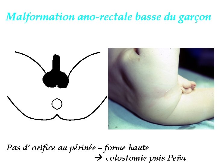 Malformation ano-rectale basse du garçon Pas d’ orifice au périnée = forme haute colostomie