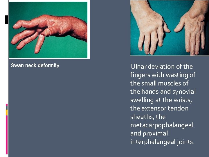 Swan neck deformity Ulnar deviation of the fingers with wasting of the small muscles