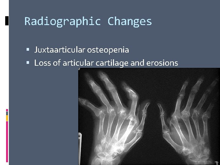 Radiographic Changes Juxtaarticular osteopenia Loss of articular cartilage and erosions 