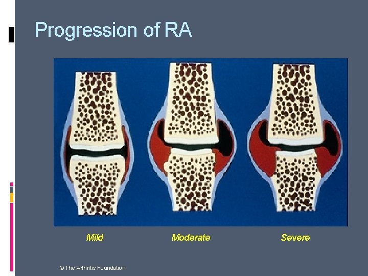 Progression of RA Mild © The Arthritis Foundation Moderate Severe 