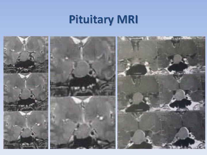 Pituitary MRI 