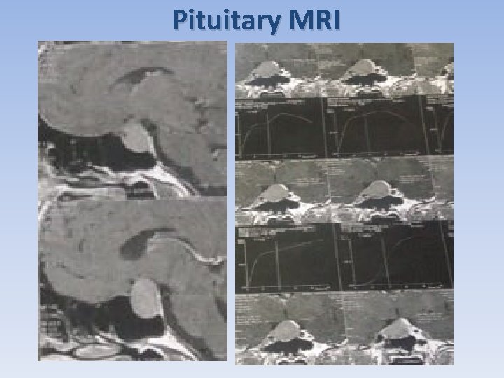 Pituitary MRI 