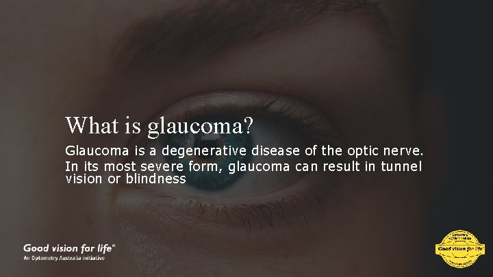 What is glaucoma? Glaucoma is a degenerative disease of the optic nerve. In its