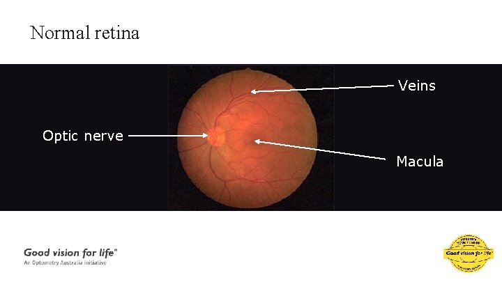 Normal retina Veins Optic nerve Macula 