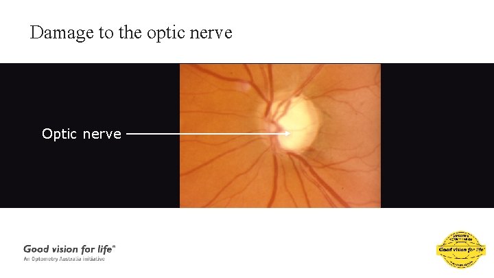 Damage to the optic nerve Optic nerve 