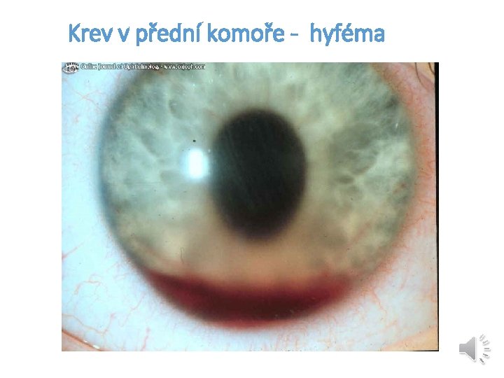 Krev v přední komoře - hyféma 