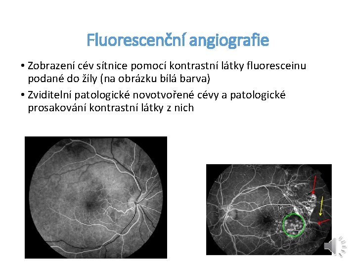 Fluorescenční angiografie • Zobrazení cév sítnice pomocí kontrastní látky fluoresceinu podané do žíly (na