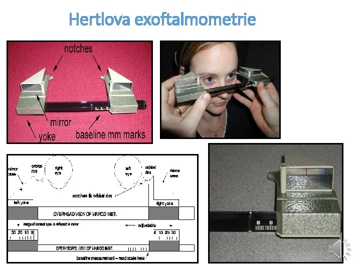 Hertlova exoftalmometrie 