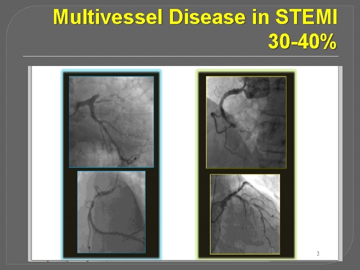 Multivessel Disease in STEMI 30 -40% 