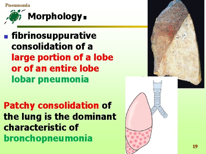 Pneumonia Morphology n . fibrinosuppurative consolidation of a large portion of a lobe or